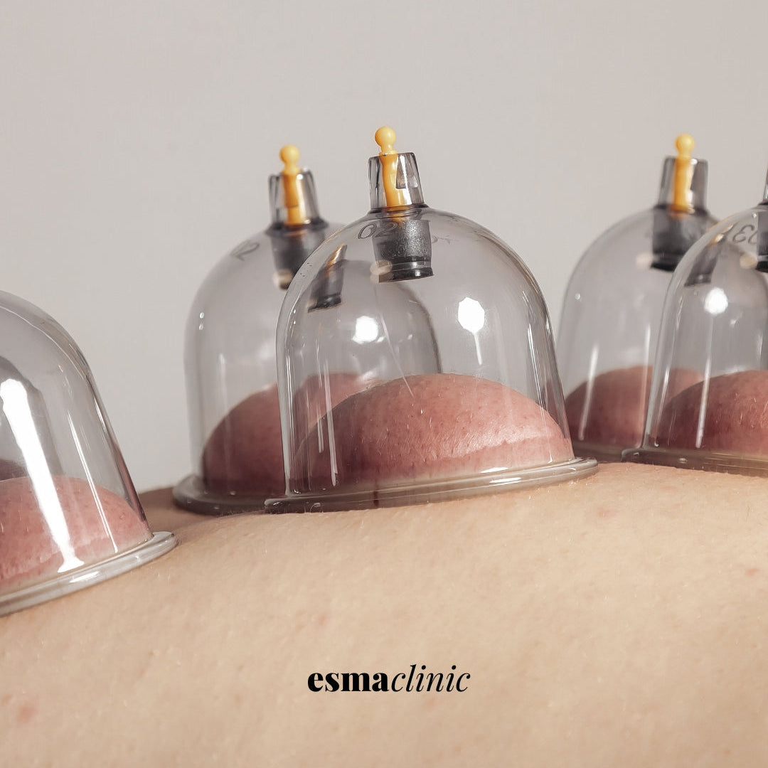 Wet Cupping | Hijama