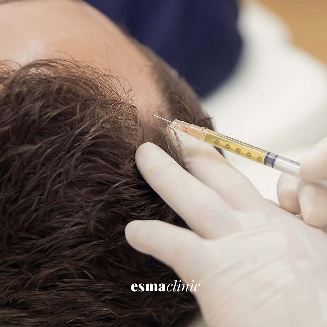 PRP for Hair Loss