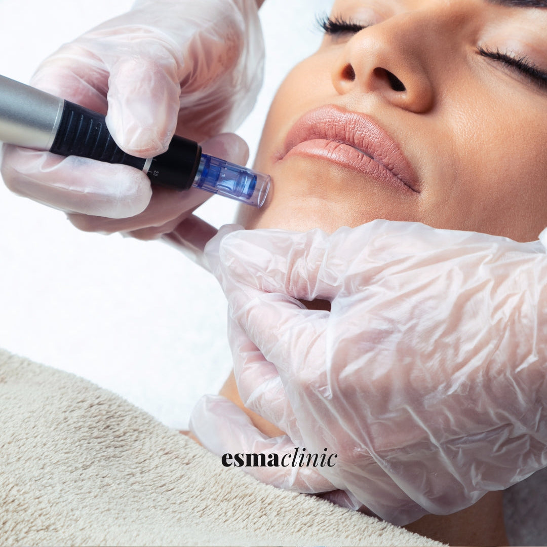 Microneedling
