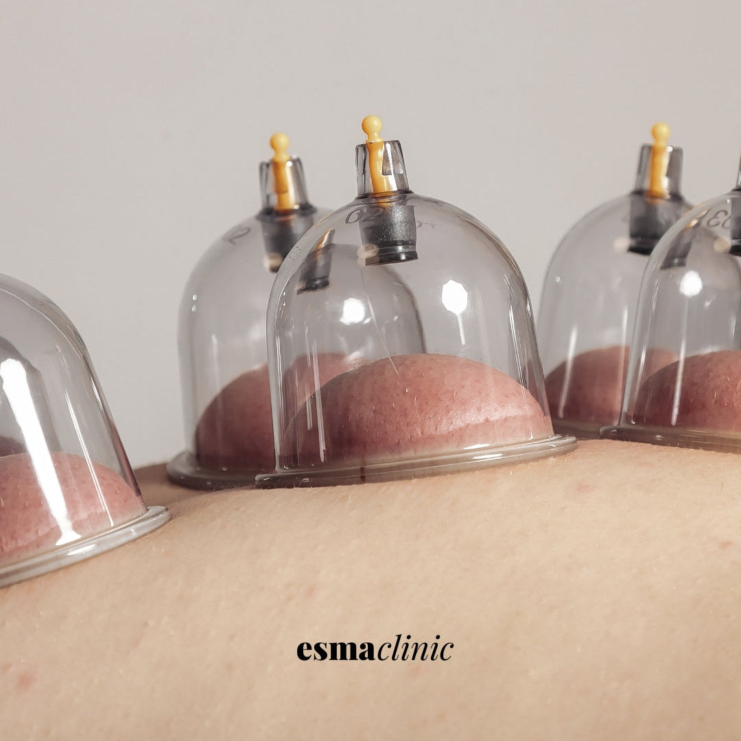 Unlimited Wet Cupping + B12 Injection
